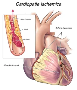 Cardiopatia ischemică este afecțiunea caracterizată de un dezechilibru intre aportul si cererea de oxigen, cel mai frecvent datorată plăcilor de ateroscleroză de la nivelul vaselor inimii - arterele coronare. Acestea in unele cazuri pot fi plăci instabile care au ca si consecință dezvoltarea infarctului miocardic acut. Pentru prevenirea acestei afecțiuni, cât si pentru imbunătățirea prognosticului, controlul factorilor de risc cardiovascular este esențial. Simptomele cardiopatiei ischemice sunt durerea precordială, numită angină pectorală, care apare de obicei in timpului efortului fizic, putând fi insotita si de lipsă de aer – dispnee.