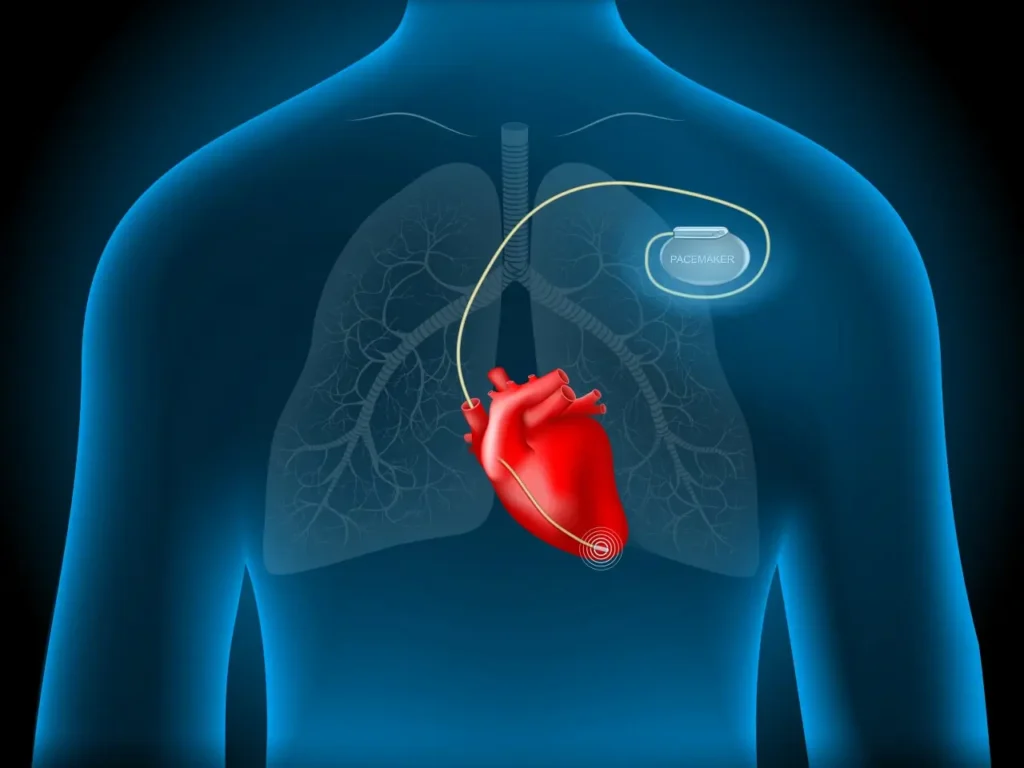 Cât de des se verifică stimulatorul cardiac