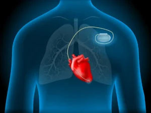 Cât de des se verifică stimulatorul cardiac? Ghid complet pentru pacienți